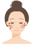 脂漏性角化症
